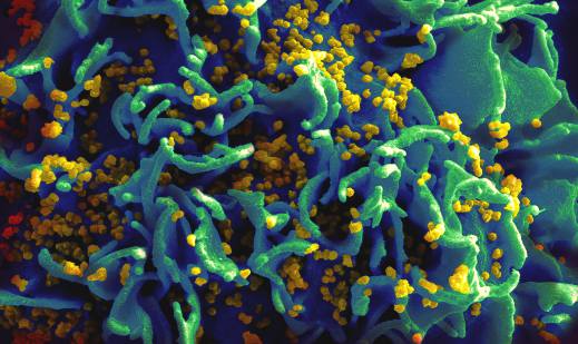 תא T מודבק בנגיפי HIV